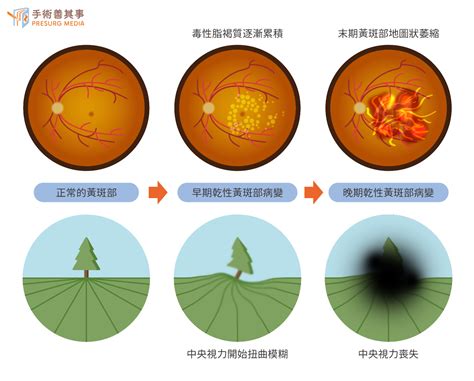 眼睛有斑|黃斑部是什麼？認識黃斑部病變症狀、治療到術後護理與保養